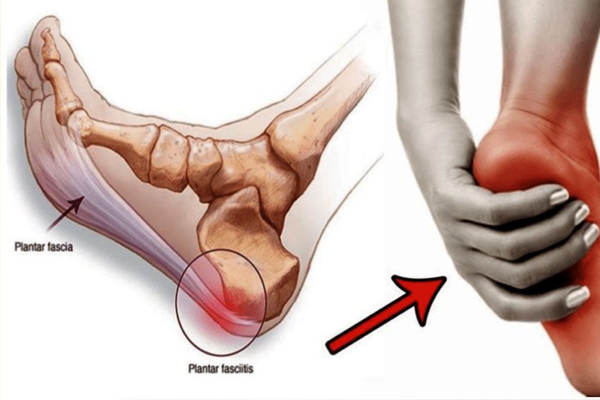 Fix Plantar Fasciitis Heel Pain in Two Simple Steps | Quick Tips - HT Physio